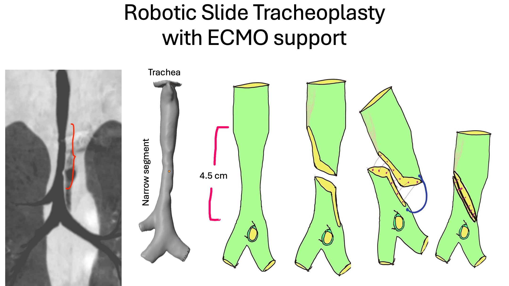 CMC Vellore Achieves Global Milestone: World’s First Paediatric Robotic Slide Tracheoplasty under ECMO Support